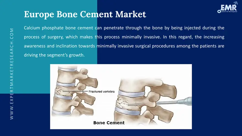 europe bone cement market