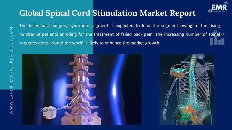 spinal cord stimulation market